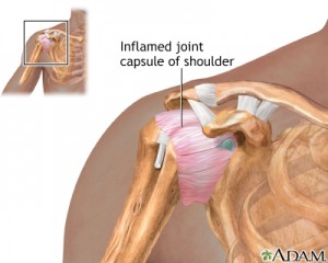 inflamed joint capsule of the shoulder. frozen shoulder, adhesive capsulitis on chiropractor.com