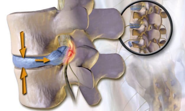 Can Chiropractic Treatment Help a Herniated Disc?