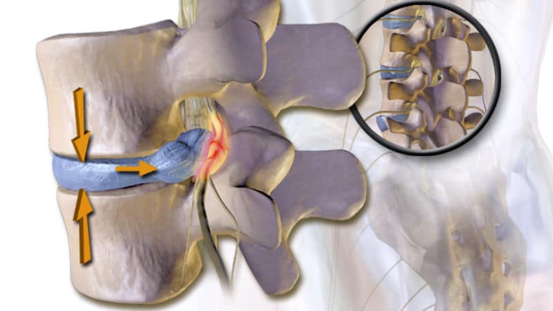 Can Chiropractic Treatment Help a Herniated Disc?