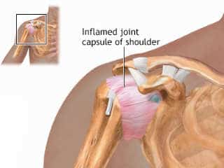 Chiropractic for Frozen Shoulder Adhesive Capsulitis