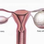 Ovarian Cysts, Tumors