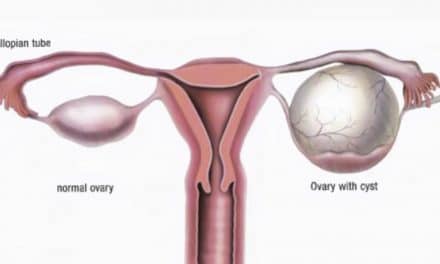Ovarian Cysts, Tumors
